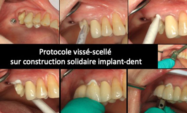 Prothèses fixées sur dents et implants : proposition et justification d’un protocole original