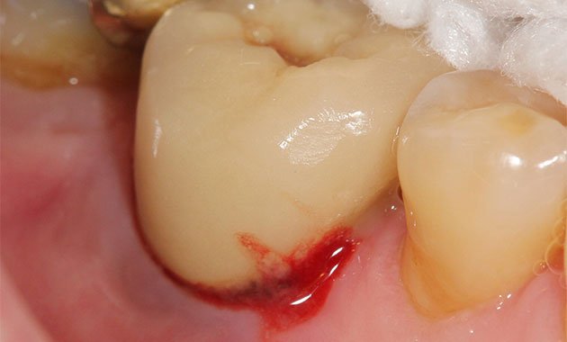 L’implant en zircone : plus proche de la racine naturelle ?