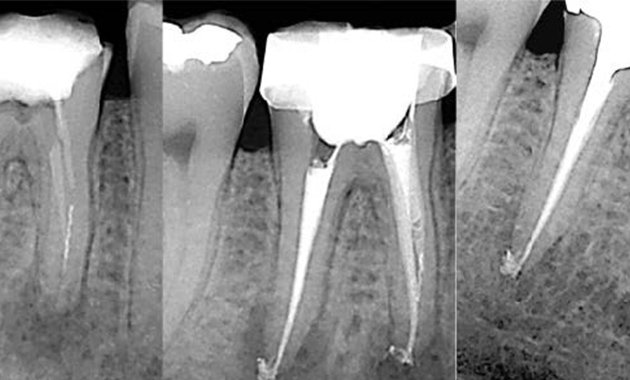 Cinq réponses pour cinq questions fréquentes en endodontie