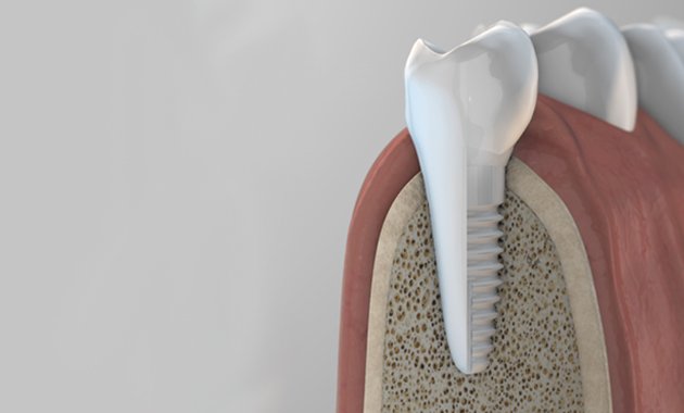 Le catalogue de Biotech Dental s’enrichit d’un nouvel implant céramique