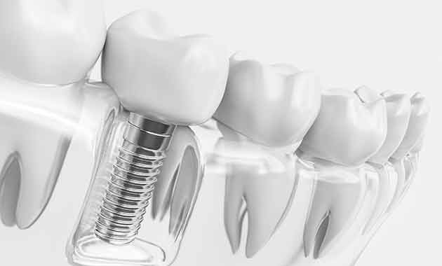 Dentisterie implantaire : une pratique du quotidien