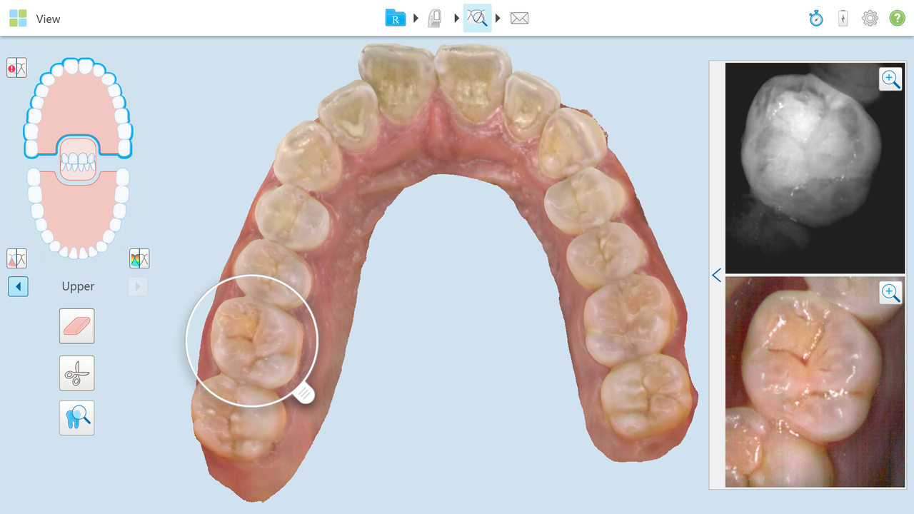 Vers une meilleure détection des caries interproximales