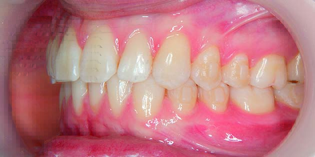 RMO – Orthocaps : Taquets préformés adaptés à la teinte des dents