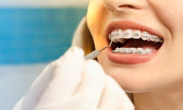 Sondage : plus d’un Français sur deux aurait déjà eu recours à des soins orthodontiques