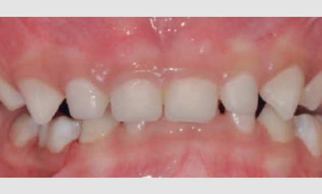 Coiffes préformées pour dents temporaires
