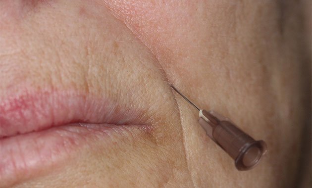 Les injections d’acide hyaluronique : quelques précautions à prendre