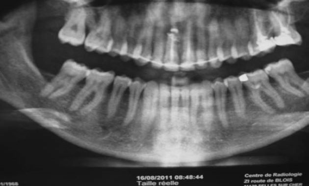 Pose de deux implants en secteur antérieur