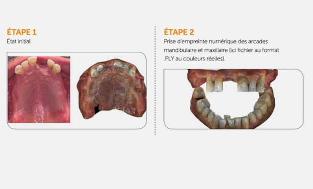 Prothèse amovible : un flux numérique complet en deux rendez-vous