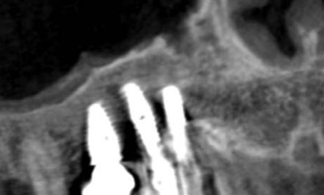 Suivi clinique et radiologique du remaniement osseux après greffe osseuse du sinus maxillaire