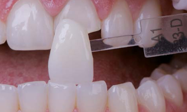 Détermination précise de la couleur des dents