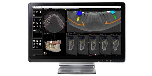 Stand 3M20 Carestream Dental – La planification implantaire