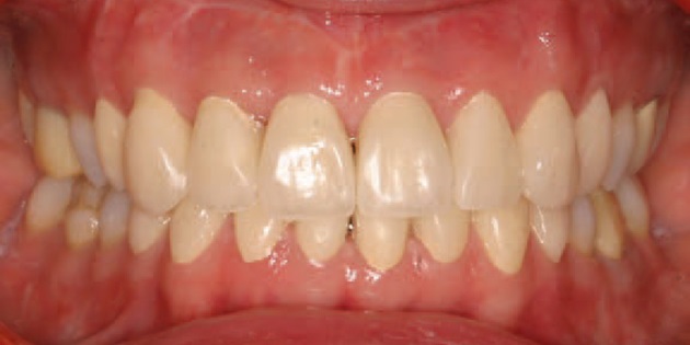 L’orthodontie dans le traitement pluridisciplinaire du sourire