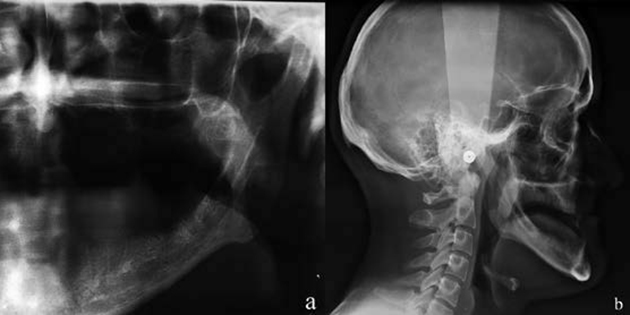 Le recours à la chirurgie orthognatique pré-prothétique / Drs A.Moret, N.Garcia, P.Revol et P.Estival