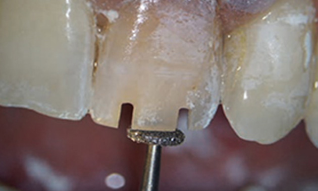CFAO – FICHE PRATIQUE N°9 – La couronne complète sur dent antérieure