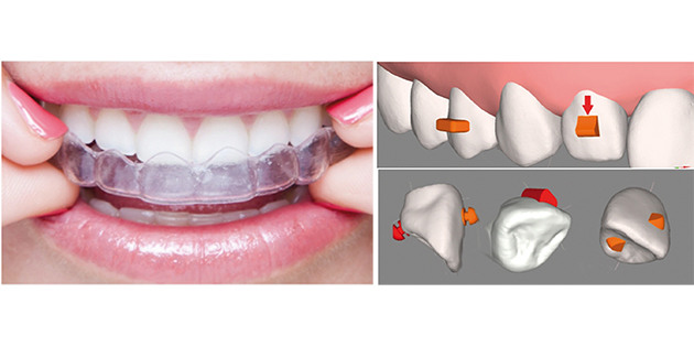 Air Nivol / Odontec – une nouvelle ligne d’aligneurs orthodontiques Air Nivol / Odontec – une nouvelle ligne d’aligneurs orthodontiques