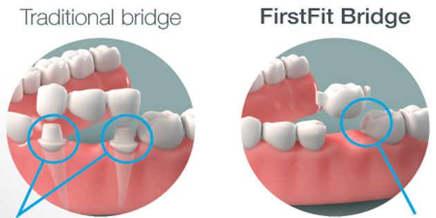 Firstfit : le pont minimalement invasif