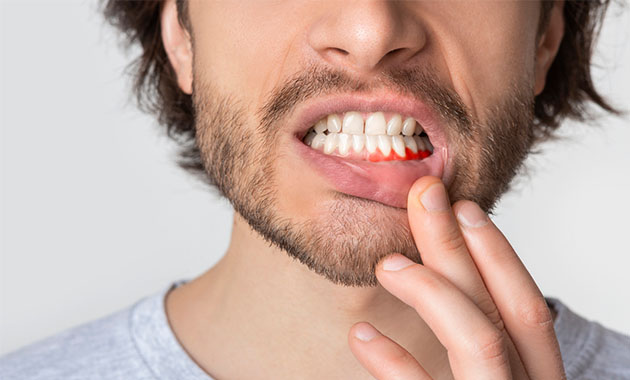 Une méthode pour traiter les inflammations gingivales