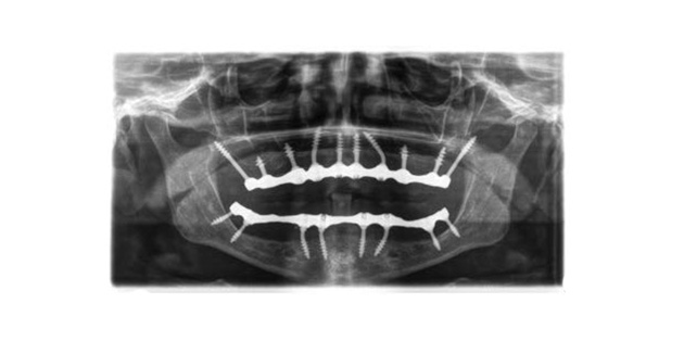 Stand 4M05 IHDE-Dental Logic Dentaire – Présentation des implants monobloc Suisses IHDE-Dental