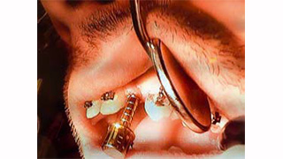 Chirurgie MIMI-Flapless : ils ont testé la formation théorique et pratique Chirurgie MIMI-Flapless : ils ont testé la formation théorique et pratique