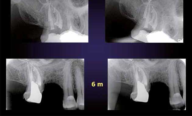 Endodontie : l’économie tissulaire du laser