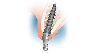 INTRA-LOCK – NOUVEAU MINI-IMPLANT 15°