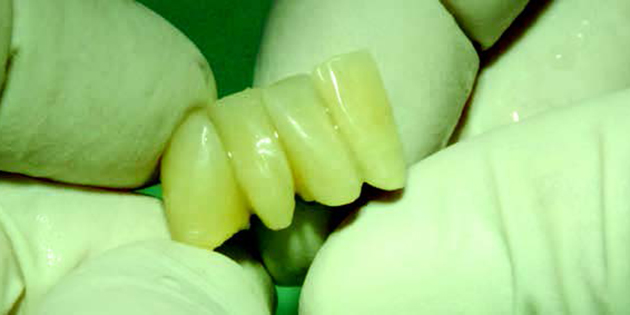 Faire une réparation en bouche rapidement