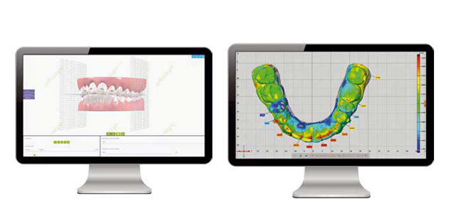 RMO-Orthocaps – Nouvelle version du Logiciel i-Setup 3-D
