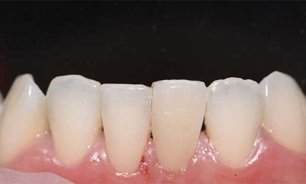 Facette dentaire unitaire : une alternative à l’orthodontie ?
