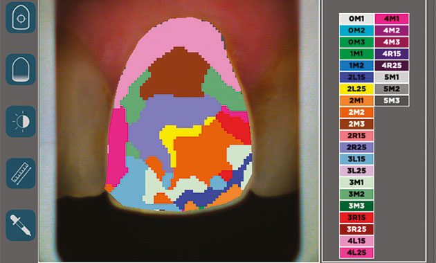 La prise de teinte en dentisterie esthétique