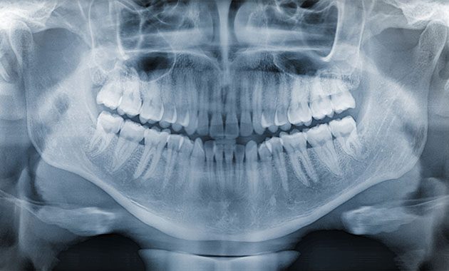 L’intelligence artificielle pour détecter la maladie parodontale