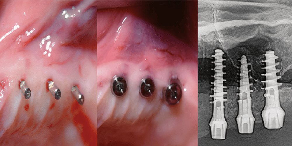 Une nouvelle approche en implantologie : le minimalement invasif