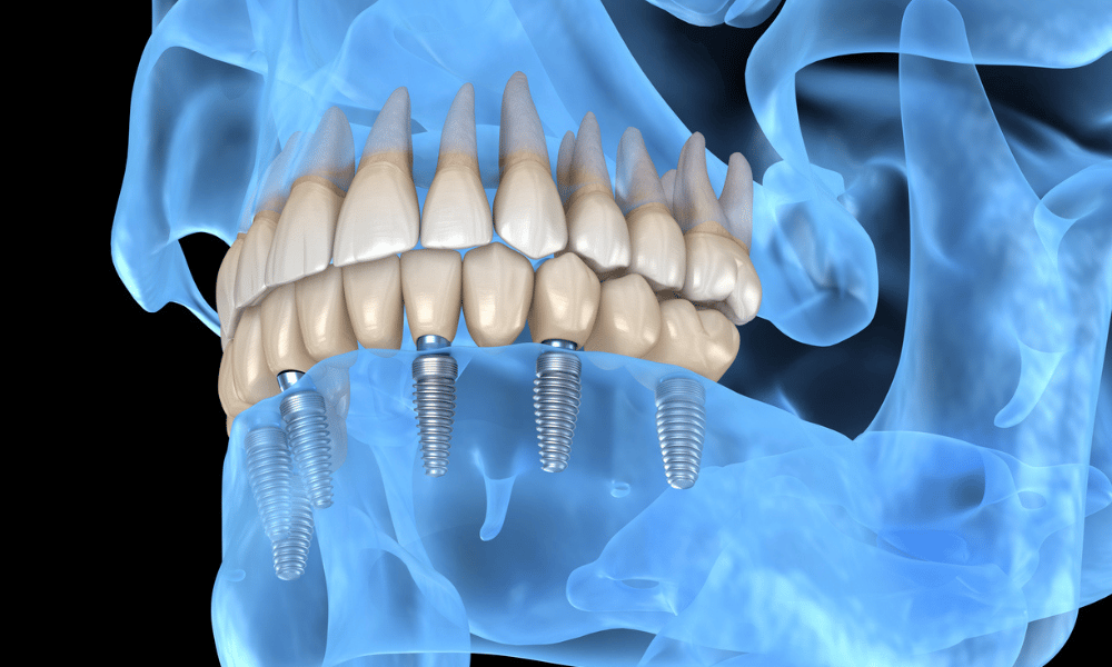 Une nouvelle étude augmente la faisabilité des implants dentaires abritant des aides auditives