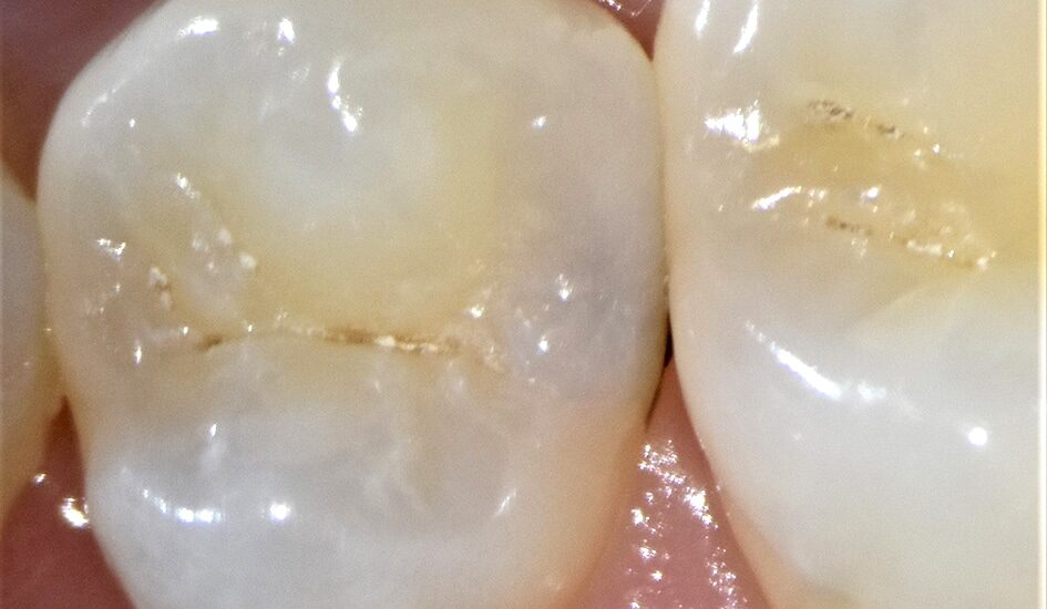 Un vernis fluoré pour reminéraliser la carie