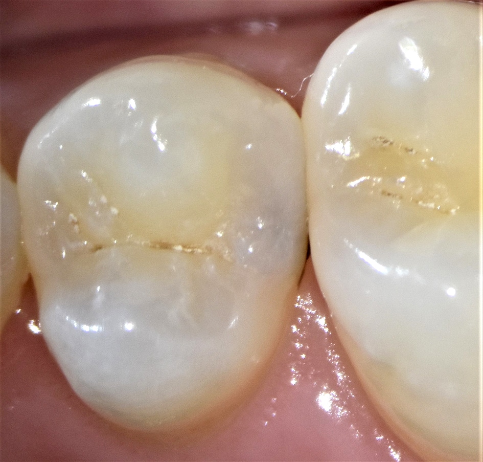 Un vernis fluoré pour reminéraliser la carie Un vernis fluoré pour reminéraliser la carie