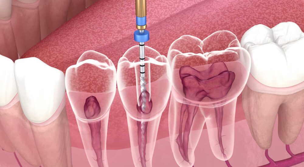 Endodontie : une lime intelligente pour éviter la casse