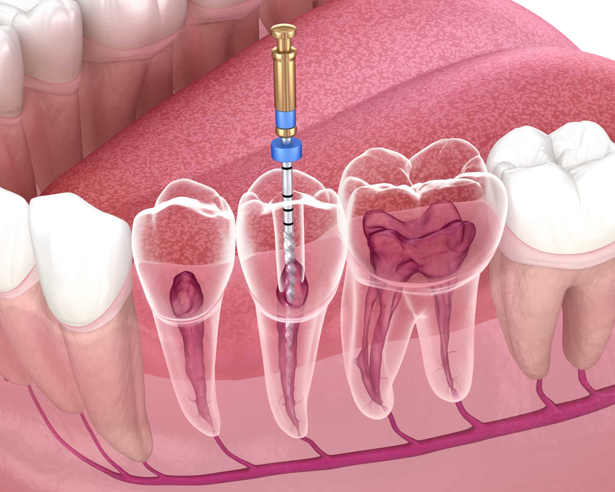 Lime endodontie