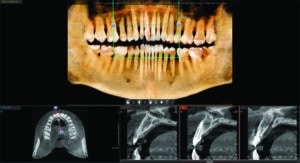 radiographie os 