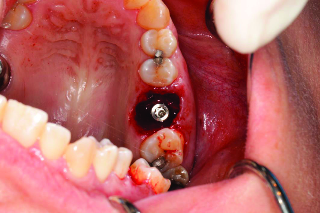 Extraction et implantation immédiate en secteur molaire et pilier SSA : chirurgie guidée versus chirurgie manuelle ? 