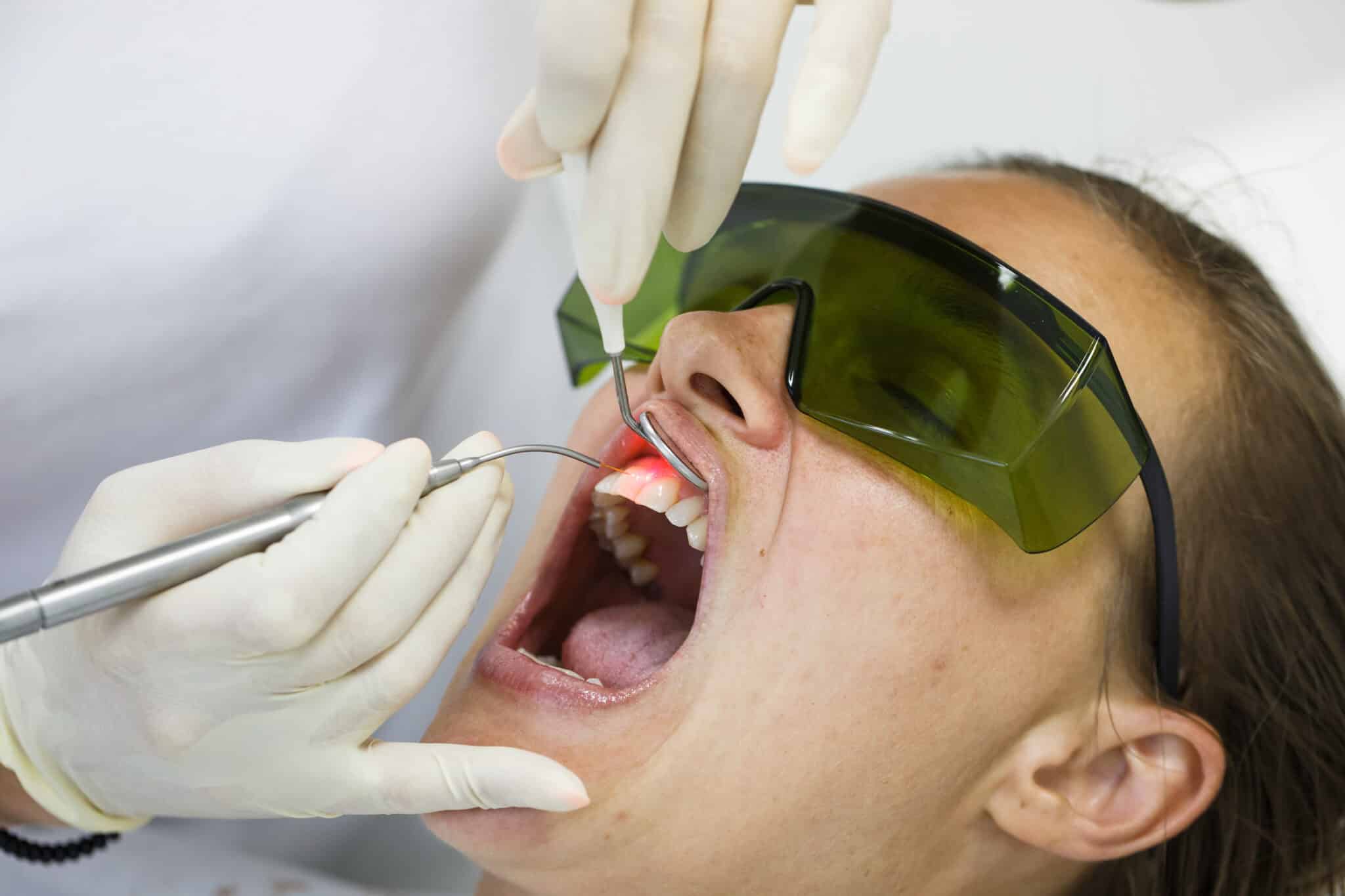 laser dentaire