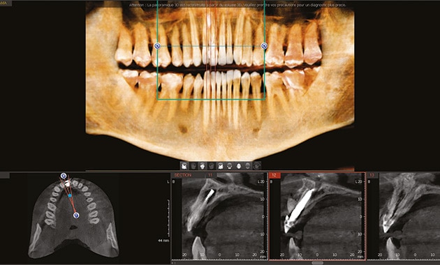 L’implant monobloc en zircone dans la zone esthétique