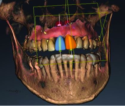 Apport du cone beam en implantologie