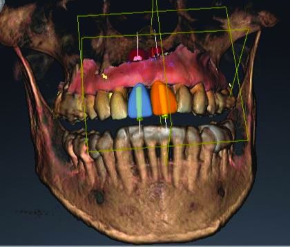 cone beam