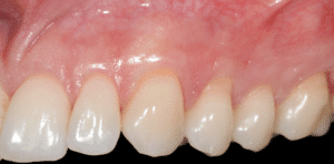 récessions gingivales