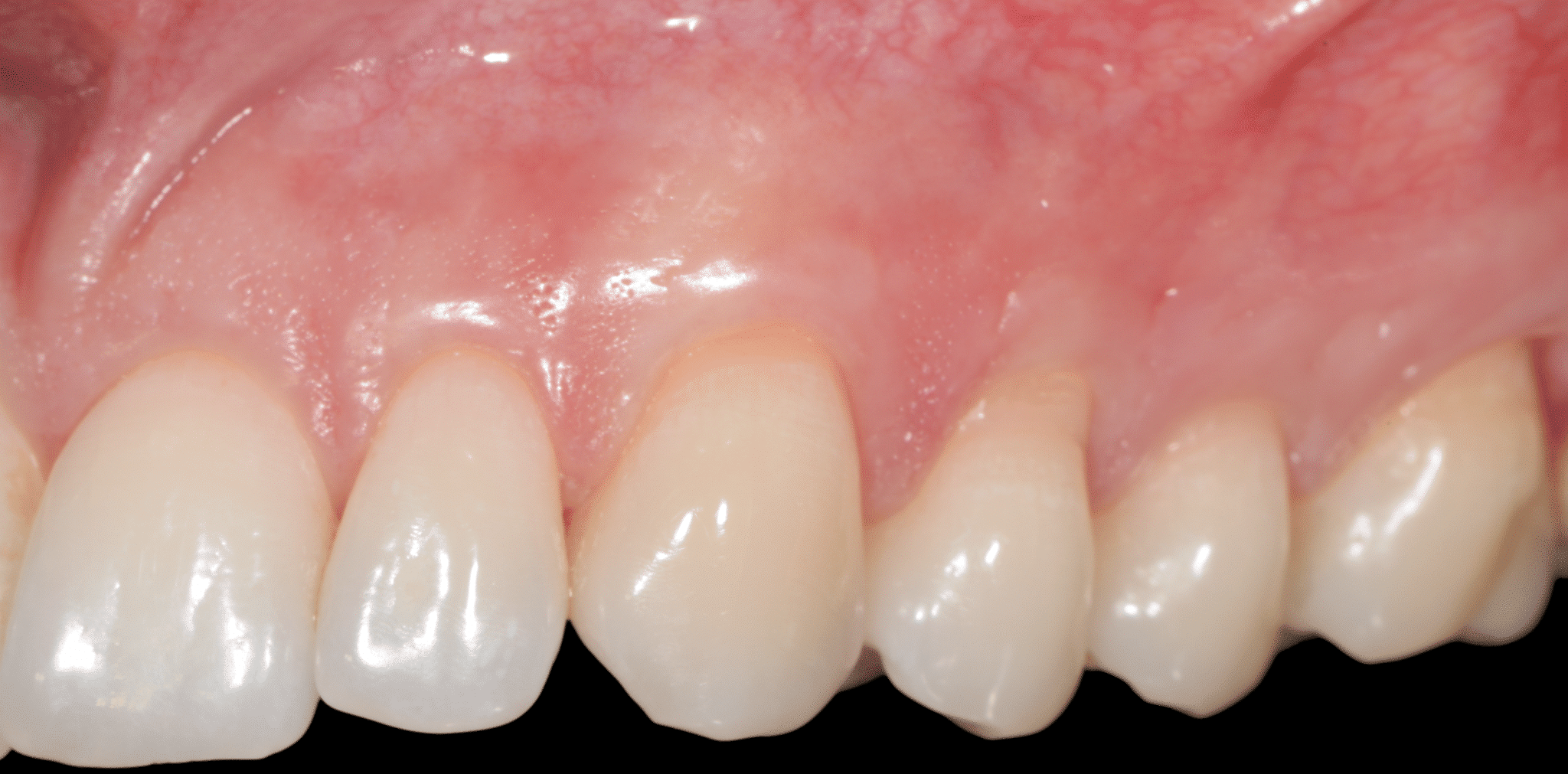 récessions gingivales