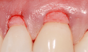 récessions gingivales