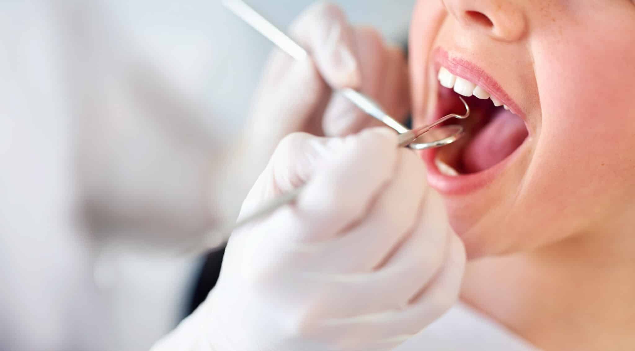 Pour l’UFSBD, le dépistage précoce des cancers buccaux est essentiel Pour l’UFSBD, le dépistage précoce des cancers buccaux est essentiel