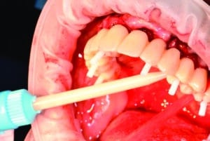 prothèse transitoire