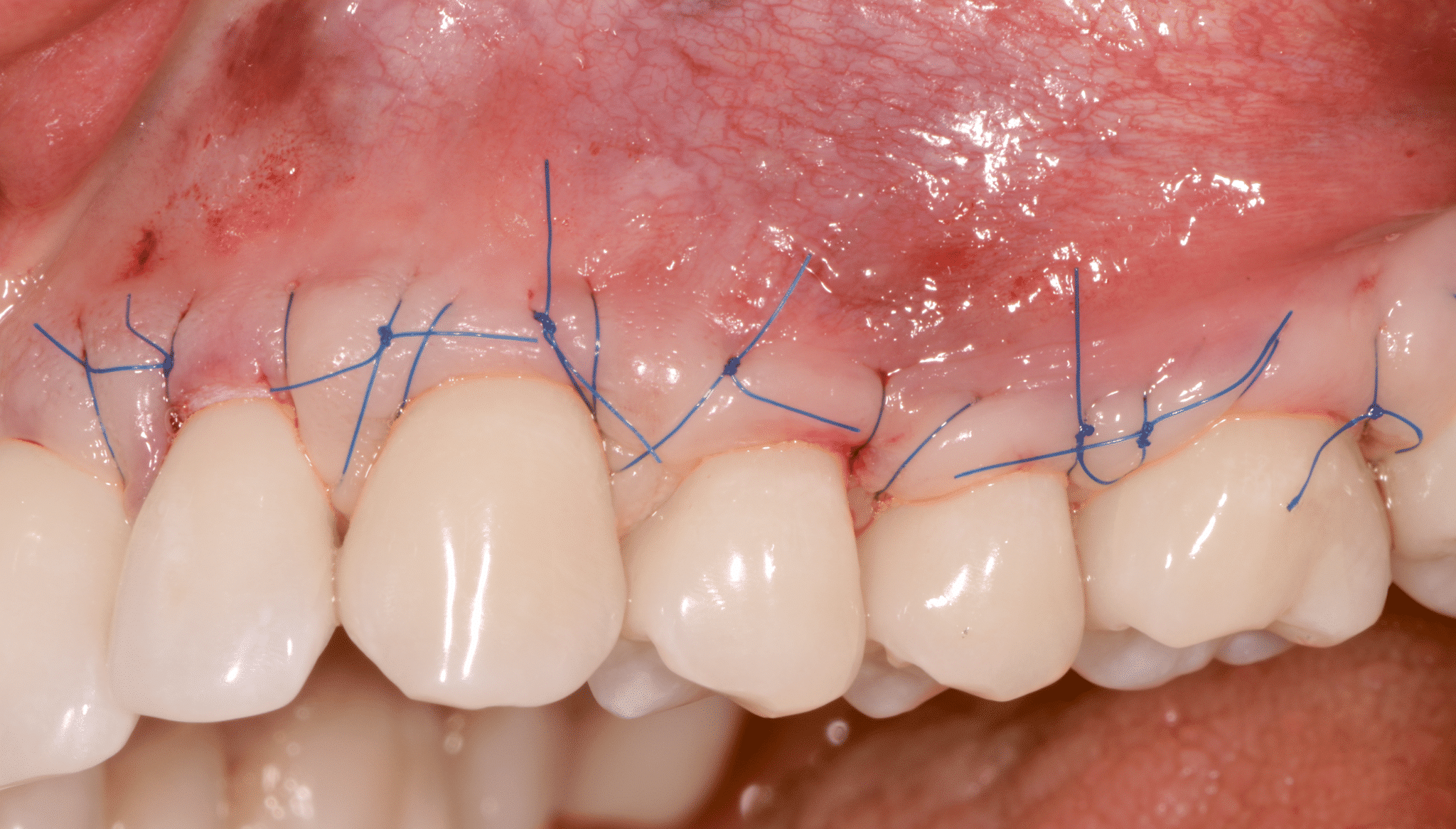 Couverture de la récession gingivale.