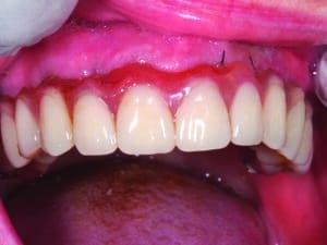 prothèse transitoire