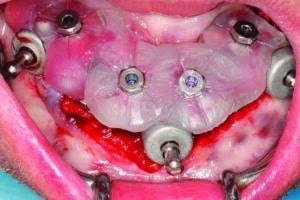 guides et implants